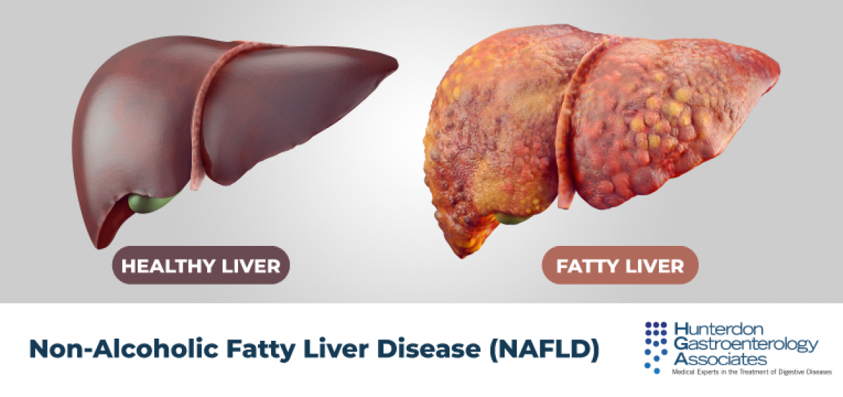 What Does Non Alcoholic Fatty Liver Disease Feel Like